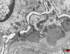 M,63y. | membranous glomerulopathy - early stage M,63y. | membranous glomerulopathy - early stage